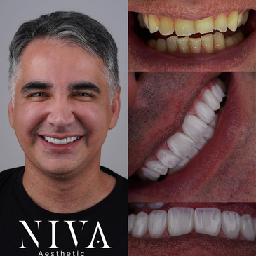 Slider image (8) Best Dental Clinic in Istanbul - Niva Aesthetic